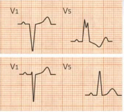 改變,在具有寬而粗鈍的r或r波的導聯(如v1導聯)中,可出現st段壓低,t